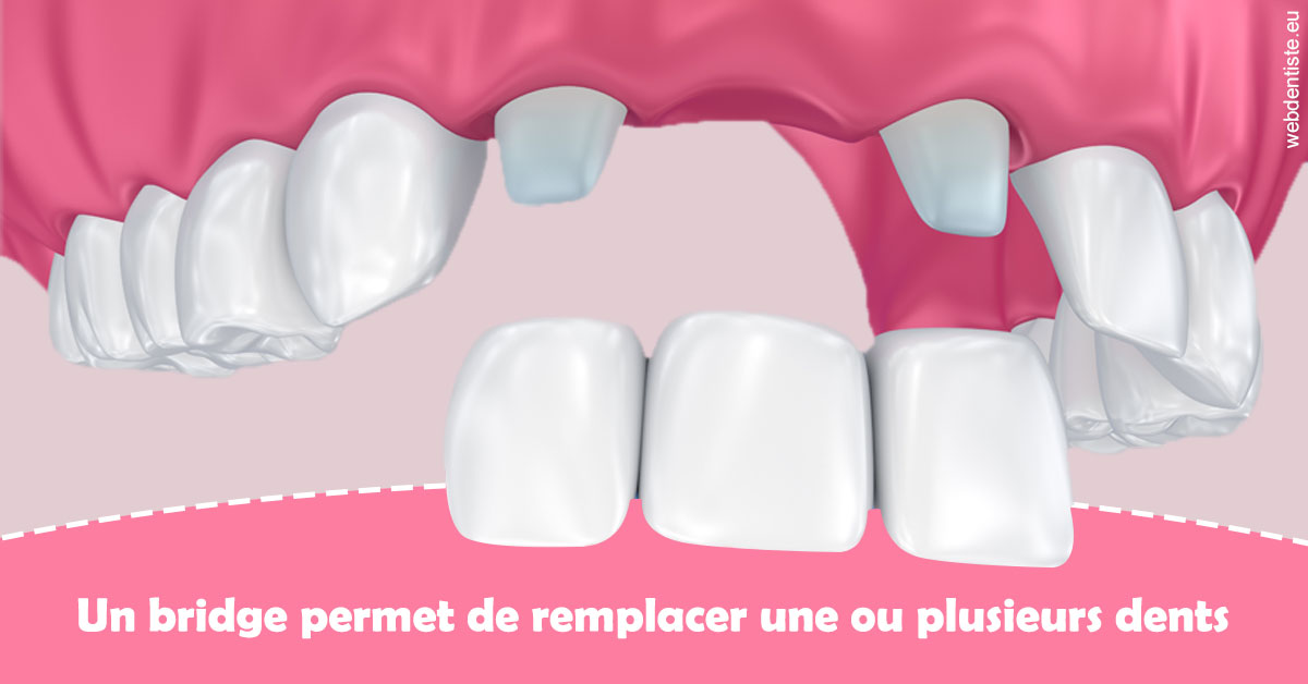 https://dr-benoit-bertini.chirurgiens-dentistes.fr/Bridge remplacer dents 2