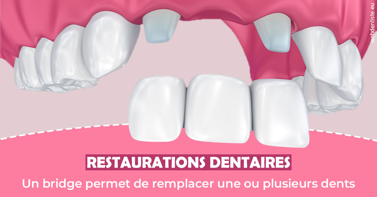 https://dr-benoit-bertini.chirurgiens-dentistes.fr/Bridge remplacer dents 2