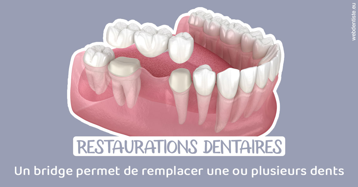 https://dr-benoit-bertini.chirurgiens-dentistes.fr/Bridge remplacer dents 1