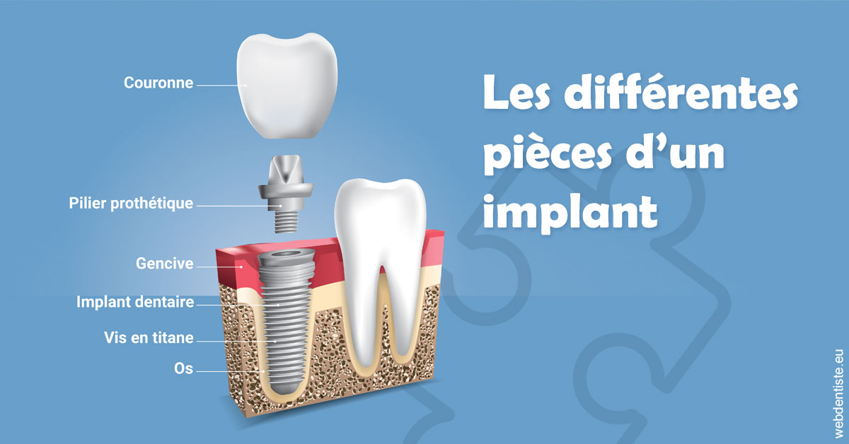 https://dr-benoit-bertini.chirurgiens-dentistes.fr/Les différentes pièces d’un implant 1
